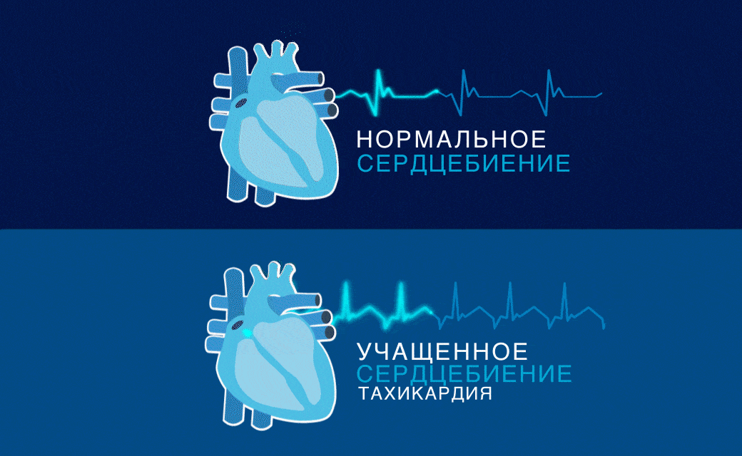 Как остановить учащенное сердцебиение в домашних условиях
